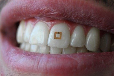 SilkLab at Tufts University developed a wearable for your teeth.