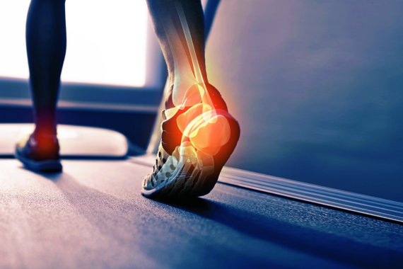Plantar fasciitis is common among hobby runners, but also professional athletes.