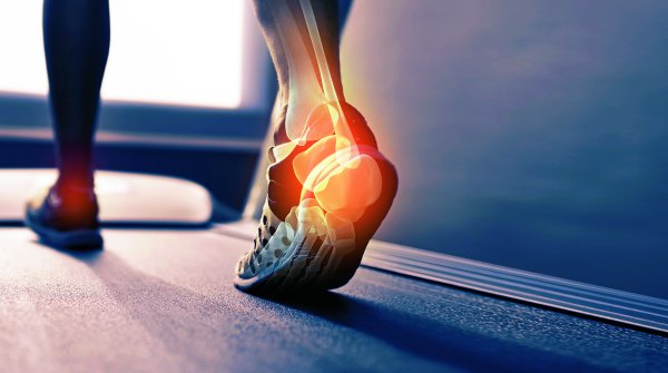 Plantar fasciitis is common among hobby runners, but also professional athletes.